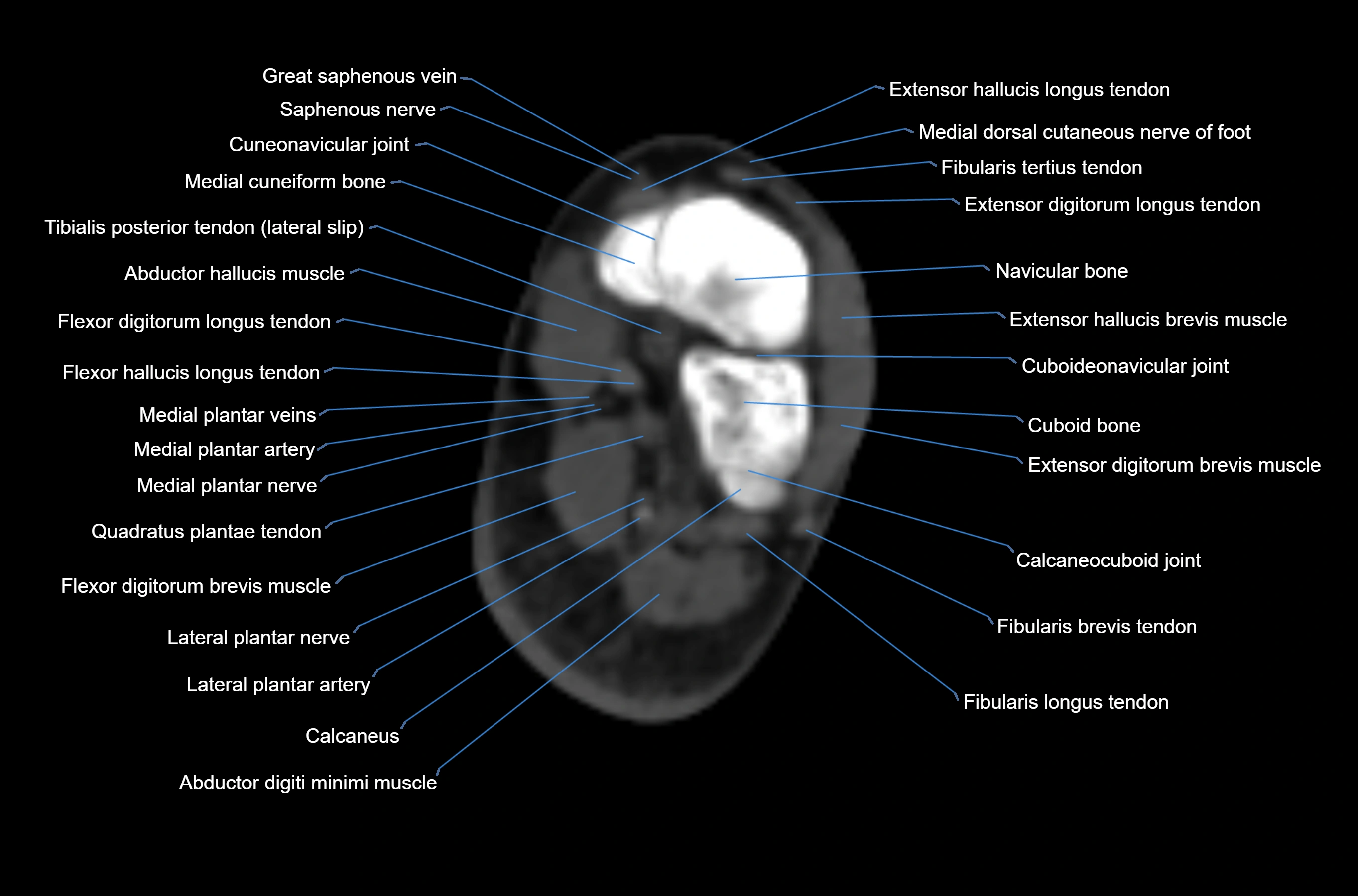 CT Ankle axial cross sectional anatomy labelled image -00048.webp